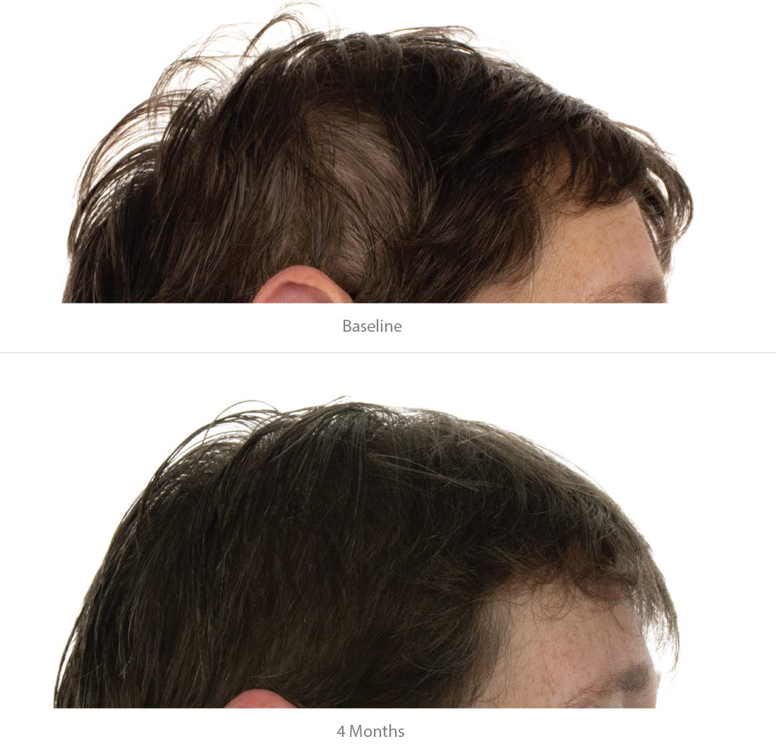FOLIGAIN® Hair Growth Shampoo + Conditioner Kit For Women with 2% TRIOXIDIL®