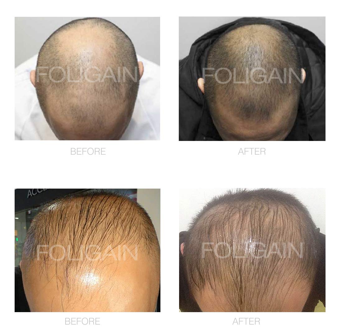 FOLIGAIN Minoxidil 5% topical solution packaging for men&