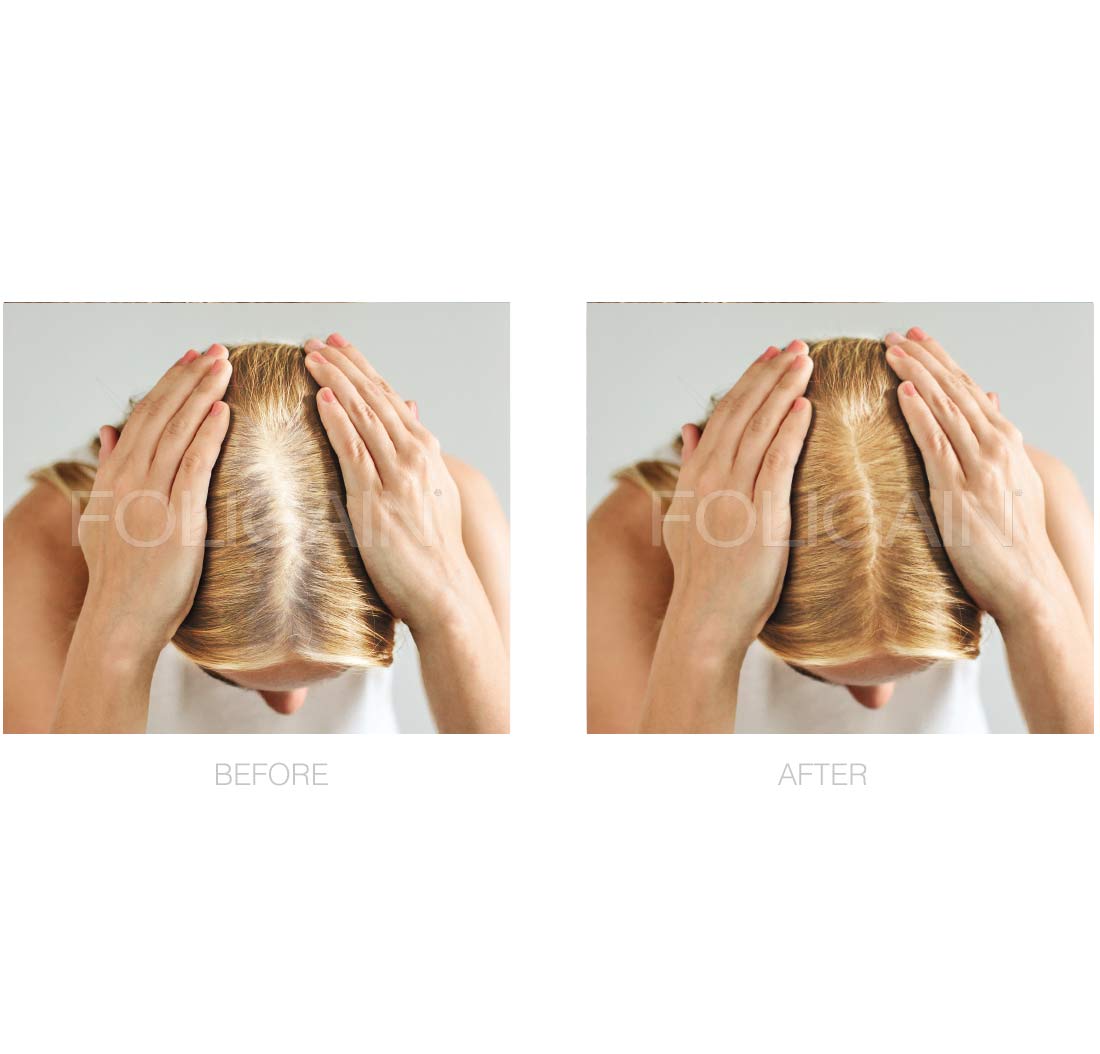 FOLIGAIN Minoxidil 2% scalp application solution for female pattern hair loss