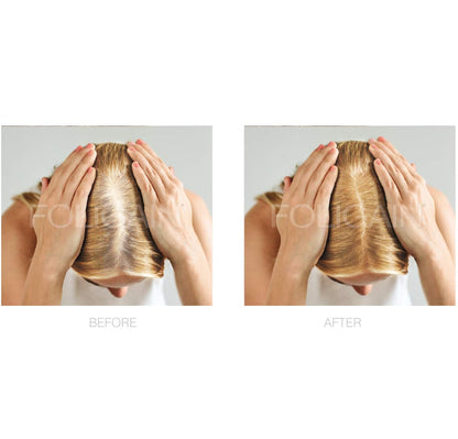 FOLIGAIN Minoxidil 2% scalp application solution for female pattern hair loss